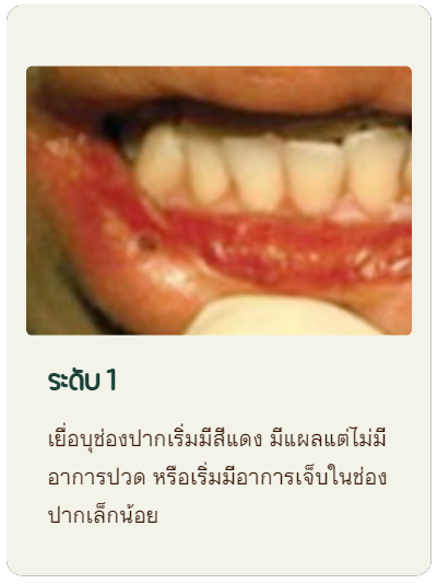 เยื่อบุช่องปากเริ่มมีสีแดง มีแผลแต่ไม่มีอาการปวด หรือเริ่มมีอาการเจ็บในช่องปากเล็กน้อย