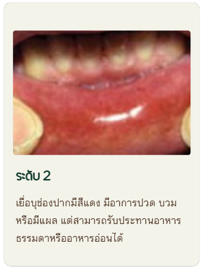 เยื่อบุช่องปากมีสีแดง มีอาการปวด บวม หรือมีแผล แต่สามารถรับประทานอาหารธรรมดาหรืออาหารอ่อนได้