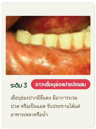 เยื่อบุช่องปากมีสีแดง มีอาการบวม ปวด หรือเป็นแผล รับประทานได้แต่อาหารเหลวหรือน้ำ