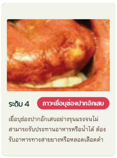 เยื่อบุช่องปากอักเสบอย่างรุนแรงจนไม่สามารถรับประทานอาหารหรือน้ำได้ ต้องรับอาหารทางสายยางหรือหลอดเลือดดำ
