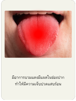 มีอาการบวมแดงมีแผลในช่องปากทำให้มีความเจ็บปวดแสบร้อน